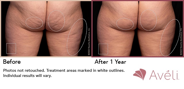 Aveli Cellulite Treatment